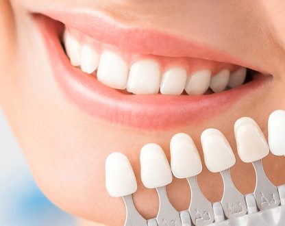 Dental Veneers in Columbia, SC, Dental Veneers near you